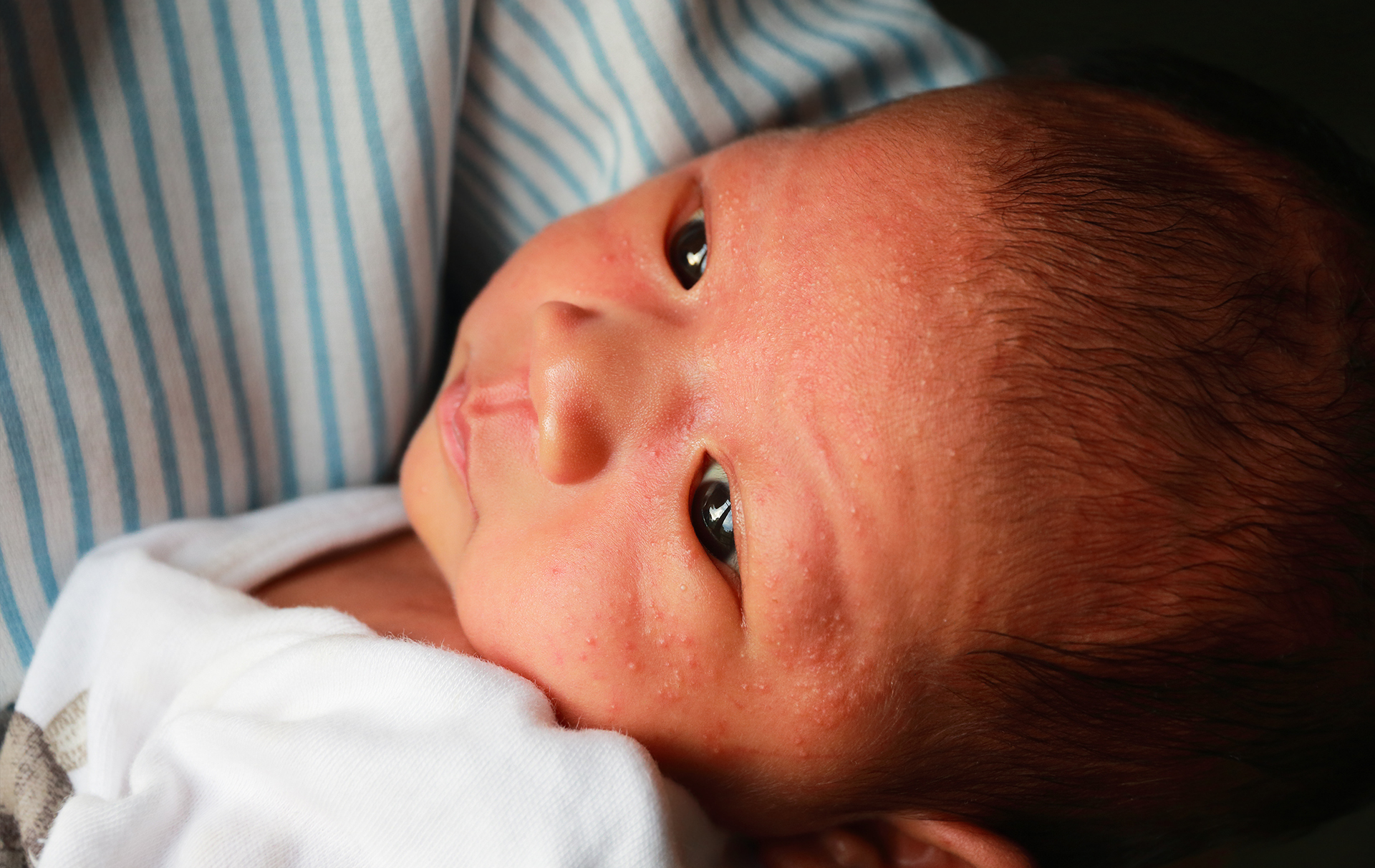 потничка у новорожденных фото на лице