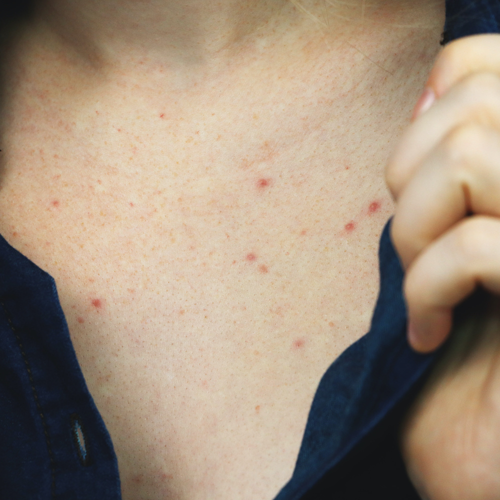  What you need to know about chest acne, according to top dermatologists 