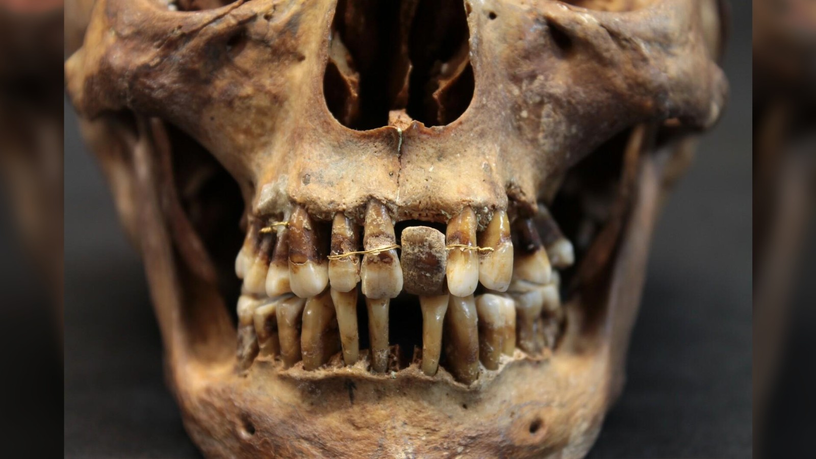 Certains des fils d'or fin étaient enroulés plusieurs fois autour des dents de D'Alègre pour les maintenir en place, tandis que certaines de ses dents avaient été percées pour laisser passer les fils.