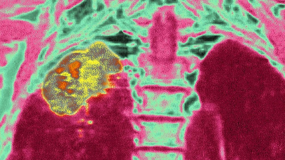 A scan of human lungs, depicted in dark red and pink, with a cancerous tumor in the upper right lung shown in yellow and orange