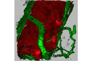 tumor cells and blood vessels