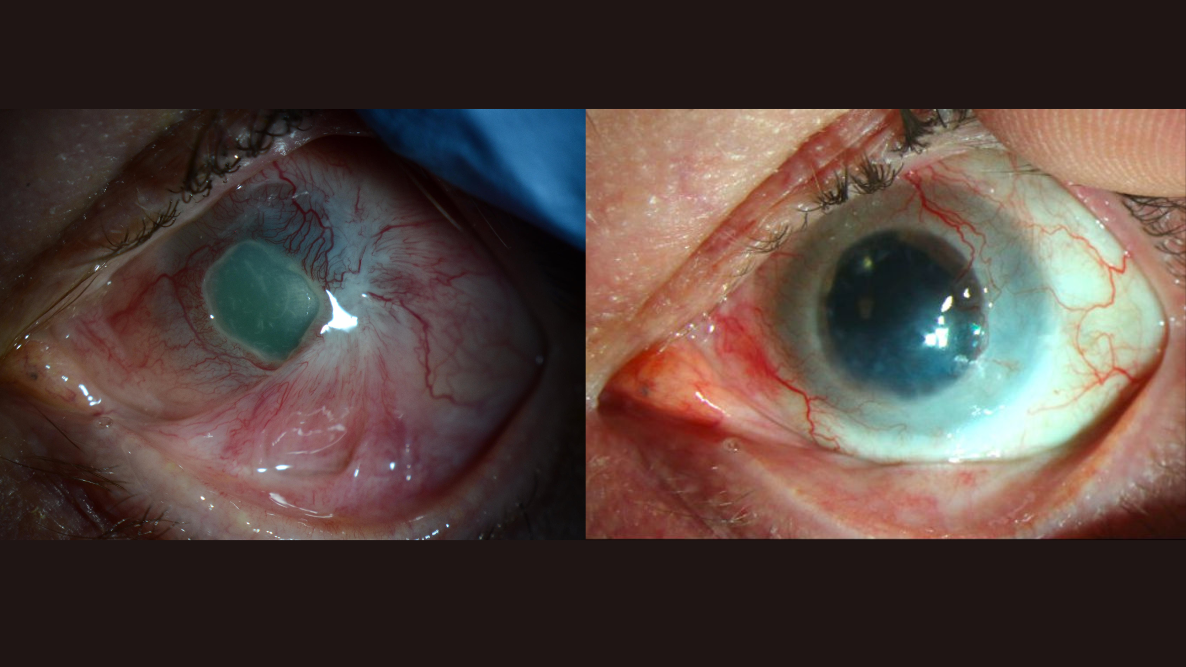 Gambar berdampingan dari kornea pasien sebelum (di sebelah kiri) dan setelah (di sebelah kanan) menerima transplantasi sel induk. Kedua gambar itu bertentangan dengan latar belakang hitam.