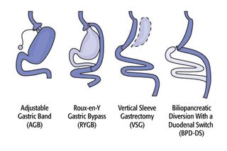 Bariatric Must Haves