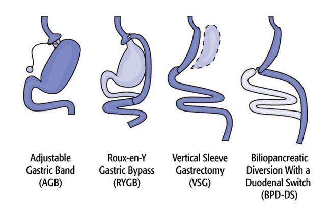 Bariatric Surgery And Weight Loss Surgery Options Live Science 2167