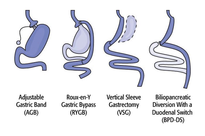 Bariatric options