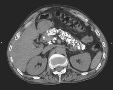 A CT scan showing numerous calcium deposits in the pancreas of a man who drank half a pint of vodka a day for 15 years.