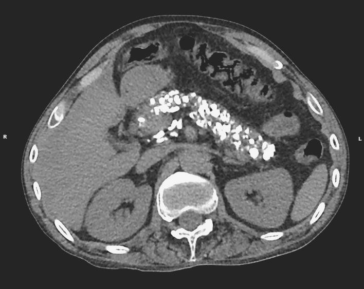 A CT scan showing numerous calcium deposits in the pancreas of a man who drank half a pint of vodka a day for 15 years.