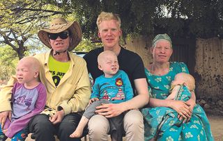 NHS doctor Oscar Duke, who you might recognise from 24 Hours in A&E, has albinism: a lack of melanin in the body.