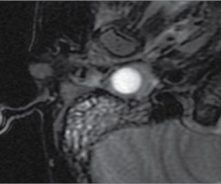 An MRI showing an expanding bead in a 9-year-old girls' middle ear cavity.