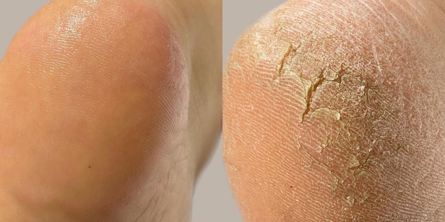 Before and after of a cracked heel after having the Elim medi pedi
