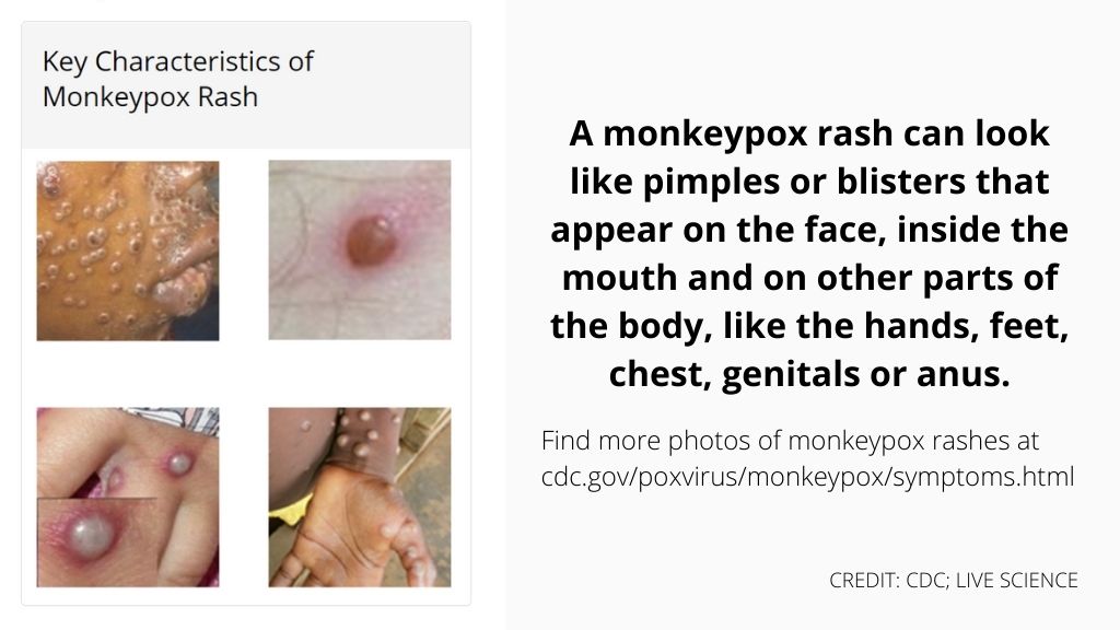 the left panel shows four photos of monkeypox rashes arranged in a grid; each rash looks like raised white, yellow or reddish pimple or cluster of many pimples and is pictured on the face, hands and arms. On the right, a statement reads: 