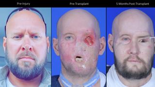 three images of a man's face next to one another. the left image shows James before his injury, with a full beard and two blue eyes. The center image shows him after he'd lost his left eye and much of his lower face. The right image shows him after surgery, with the bottom of his face now restored and a new, brown eye inserted.