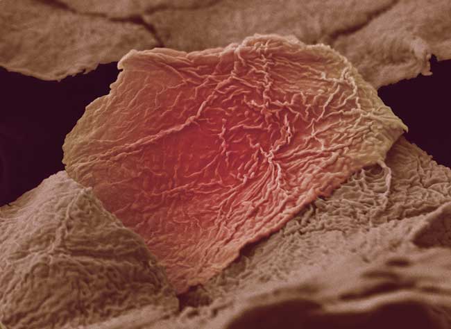 This image shows damaged skin cells from a hand (Anne Weston's own) scalded by boiling soup. The original image was black and white; the pink color has been added later. This image received an award from the Wellcome Trust, as part of the annual Wellcome