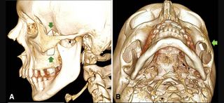 A teenage boy in Spain had a knife-like shard of glass stuck in his face for weeks after he fell into a window. Above, a 3D CT-scan of the boy's skull showing the glass shard behind his cheekbone (arrows).