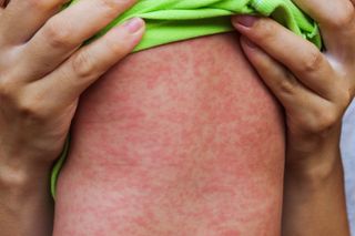 A red rash all over the body is the characteristic symptom of measles.