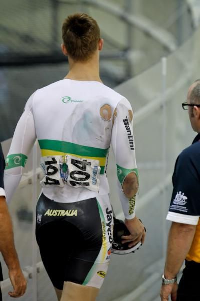 Matthew Glaetzer (AUS) shows of some battle scars