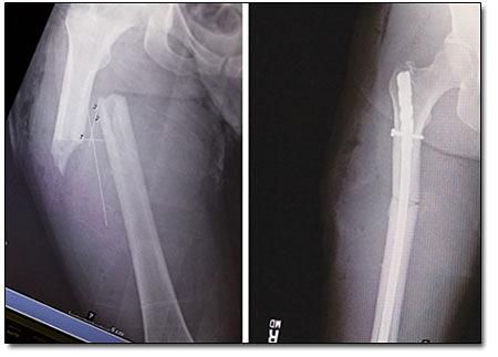 McGrath's femur x-rays before and after surgery