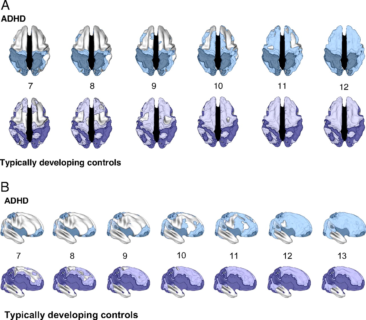 A series of graphics of a brain with different purple and blue areas shaded in.