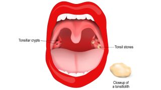 A diagram of tonsil stones 