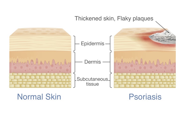 What Is Psoriasis? | Live Science