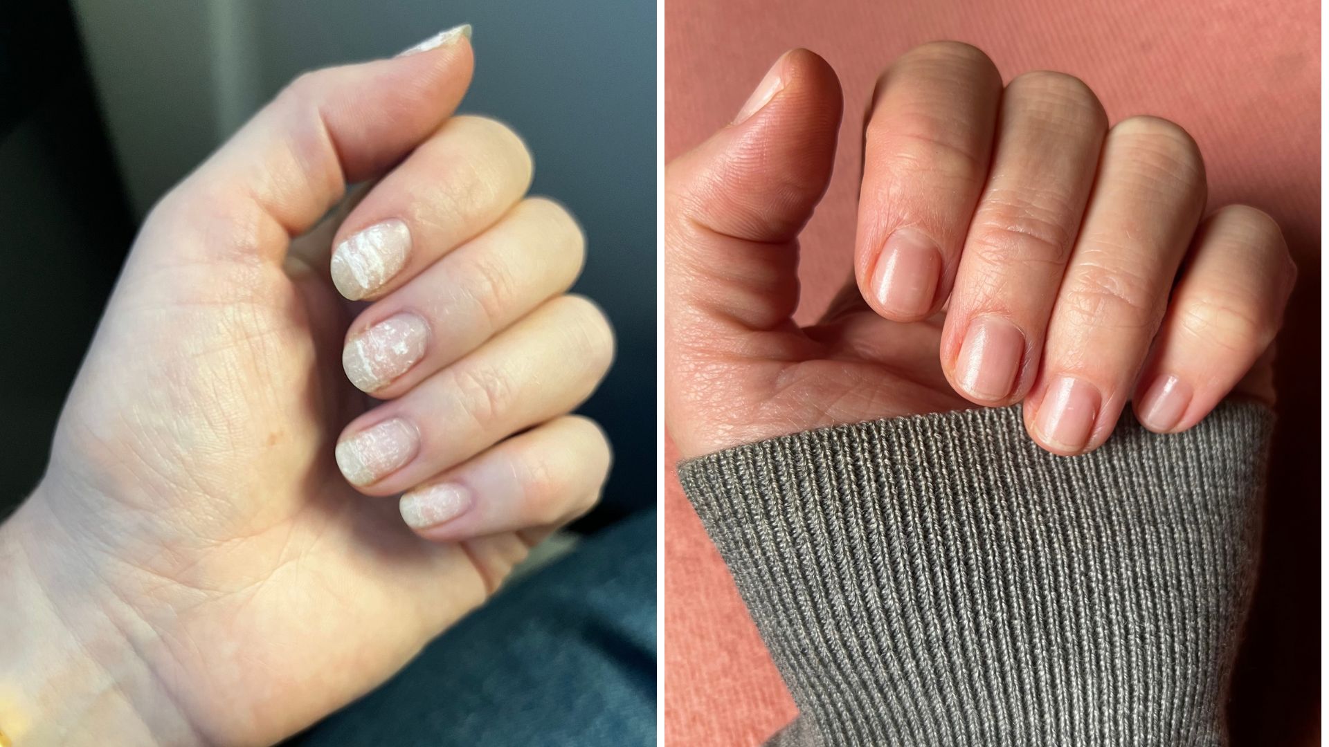 a hand with flaky, discoloured naols next to one with shiny, healthy-looking shorter nails in a grey jumper