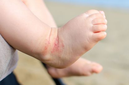 Eczema cure for children