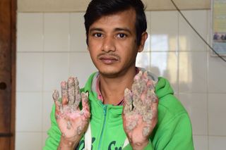 A photo of Abul Bajandar, also known as "tree man," take on Jan. 31, 2018. After 24 surgeries, the unusual growths on his hands and feet are starting to come back.