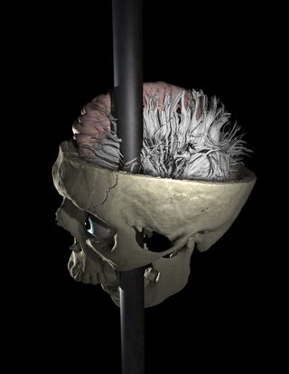 Image of the rod passing through Phineas Gage's skull and brain.