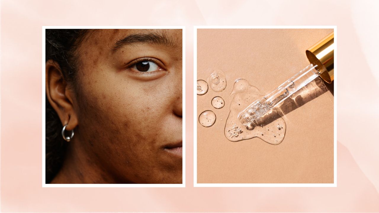 On the left, a close up of a woman&#039;s cheek with acne scarring, alongside a picture of a glass serum pipette with a clear liquid, to illustrate retinol for acne/ in a pink watercolour paint-style template