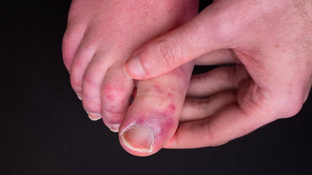 close up of a person&#039;s foot which bears reddish-purple rashes; a hand is holding the foot