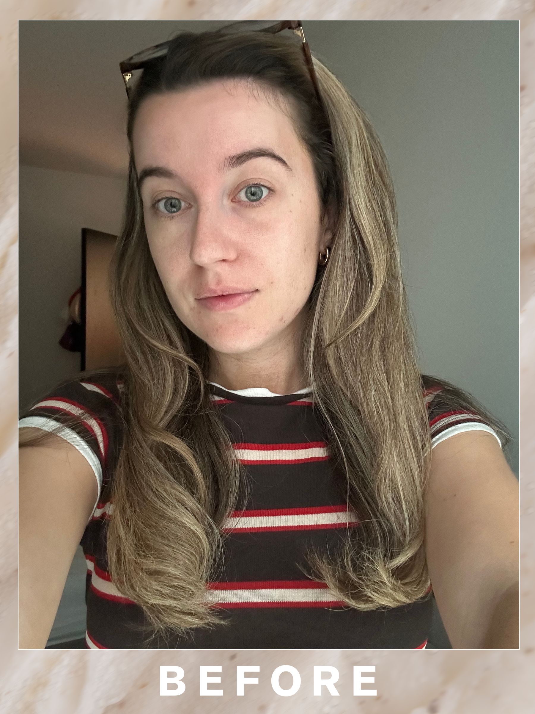 Grace before her Hydrafacial Pep9 facial