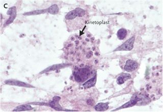 A sample of the man's brain fluid under a microscope. The image shows masses of mitochodrial DNA from the parasite, called "kinetoplasts," in macrophages.