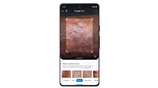 Google Lens identifying a skin condition