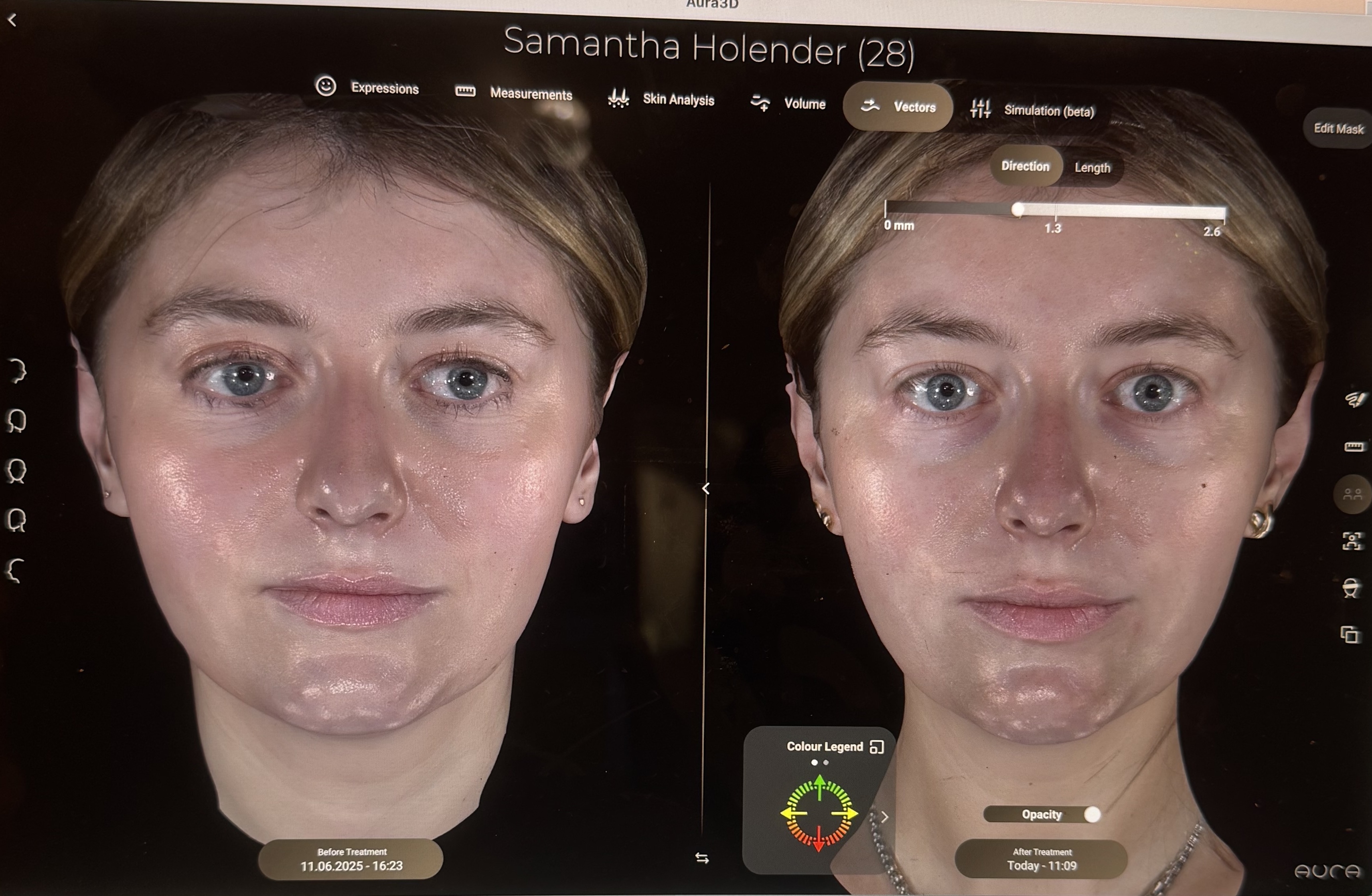 samantha holender before and after sofwave treatment