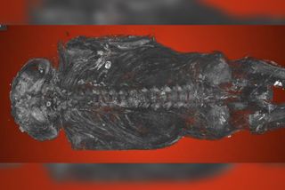 This mummy of a stillborn is one of only two or three known cases of mummies from ancient Egypt that have anencephaly. It was given to a museum in 1925, though scientists don't know where it was originally found.
