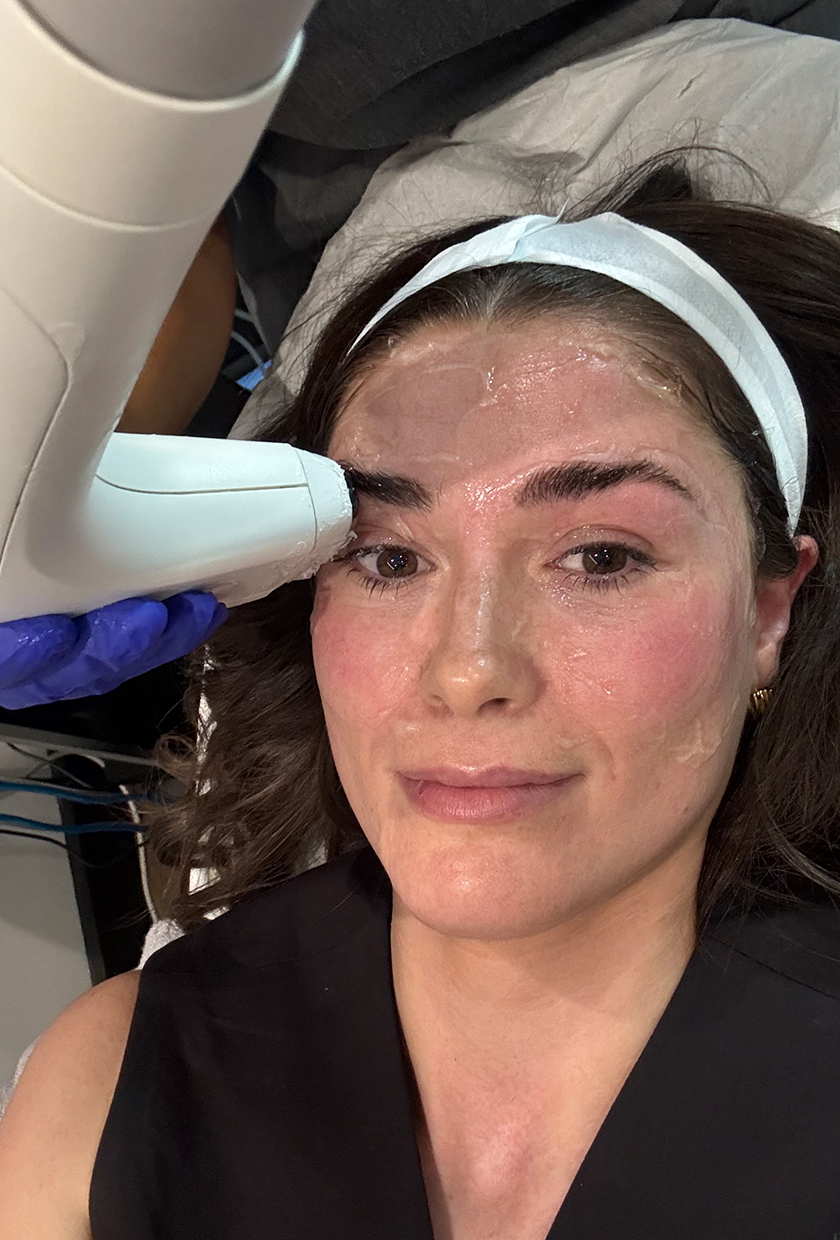 Eleanor durante el tratamiento Sofwave, con el dispositivo en sus cejas.