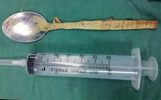 The spoon was retrieved after a procedure that lasted more than two hours.