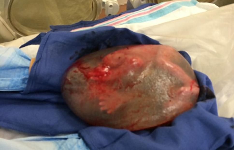 Baby born in amniotic sac.