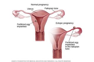 Healthy vs. ectopic pregnancy
