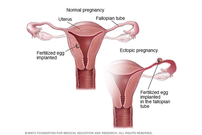 Healthy vs. ectopic pregnancy