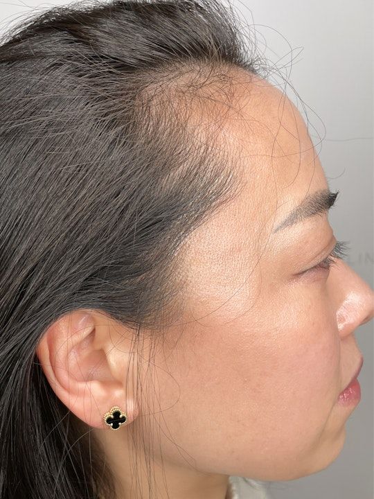 Harklinikken Hair Gain Extract Before and After