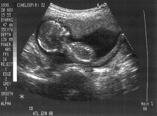 4-month-old fetus