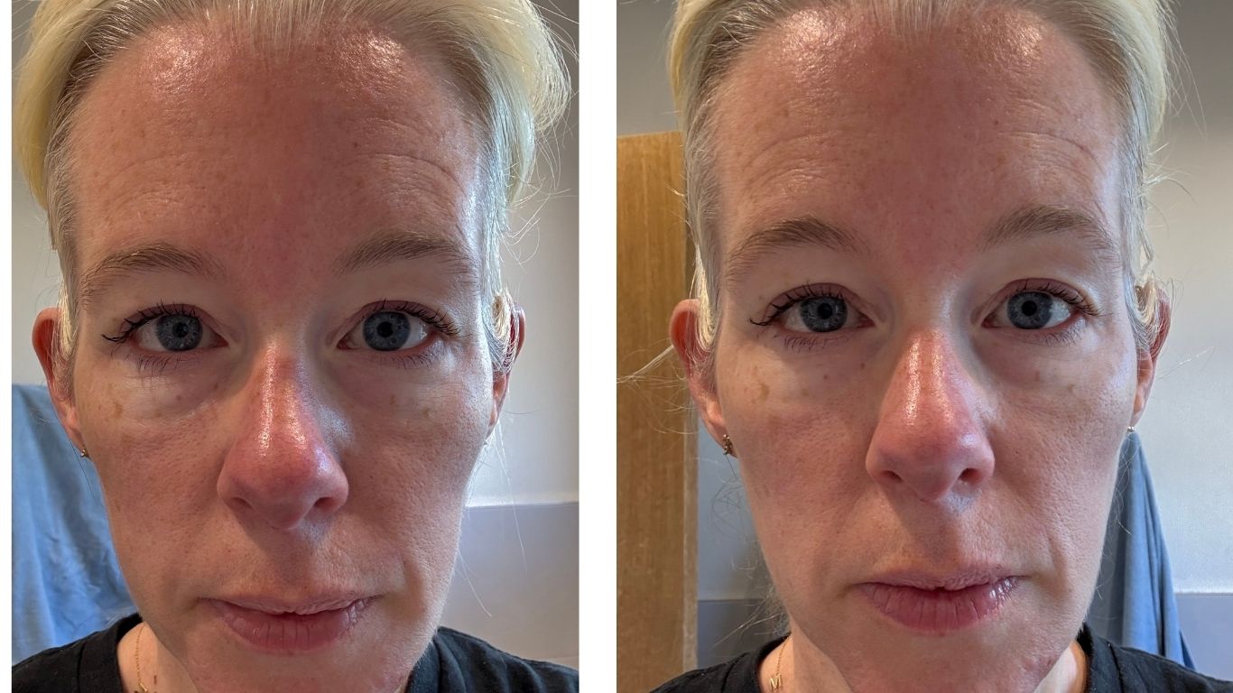 Before and after of woman's eyes after using L'Oréal Paris Revitalift Laser Instant Eye Bag Eraser