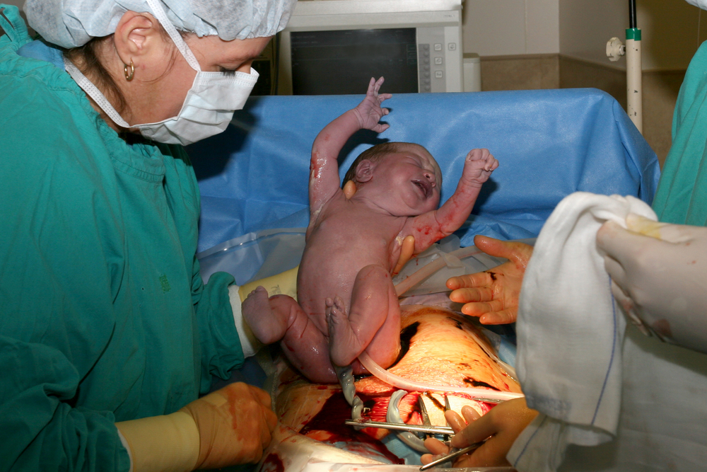 C section awake or asleep