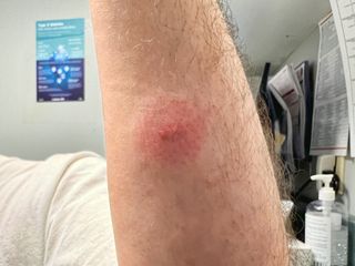 Tick bite rash