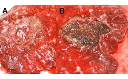 a large aspergilloma removed from a lung