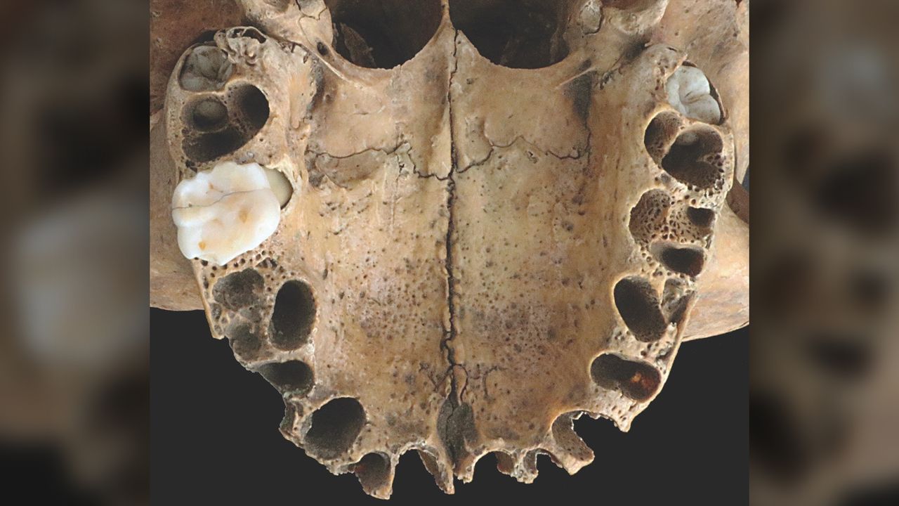A view of the teenager's upper jaw, including three of her molars.