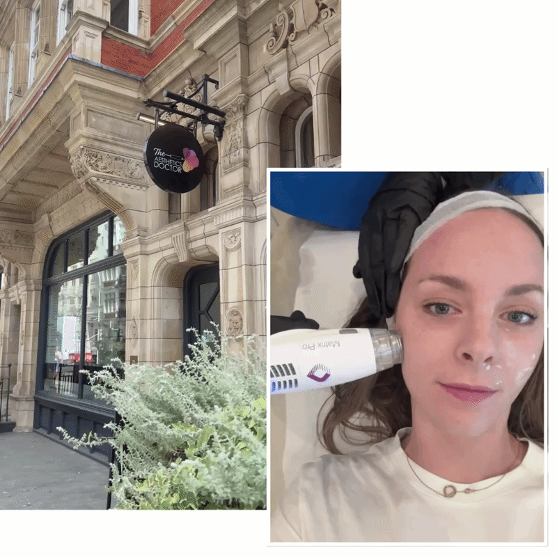 Matrix RF Microneedling