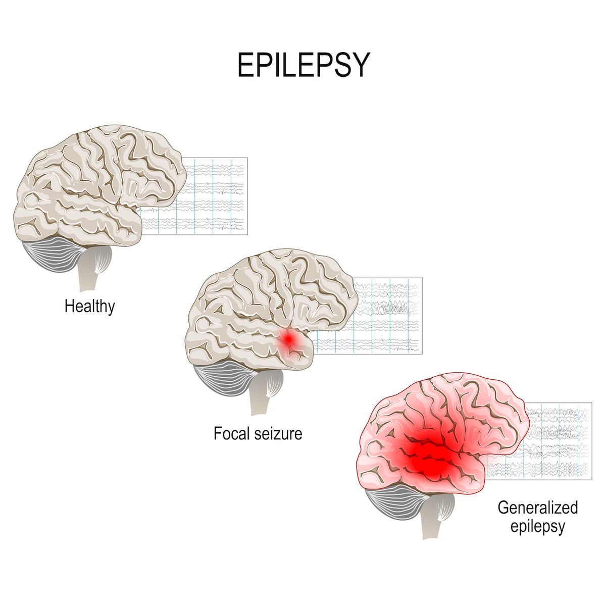 eeg normal vs epilepsy