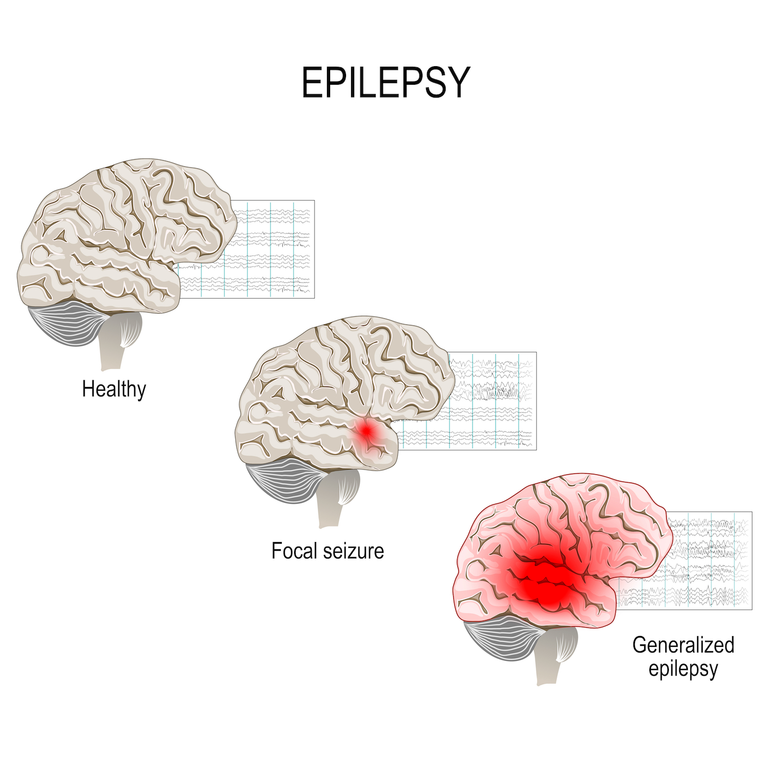 Epilepsy may cause electrical misfires throughout the brain or in one area of the brain.